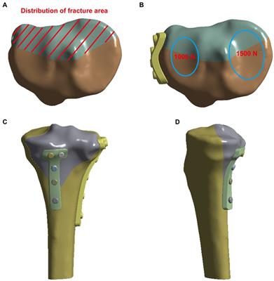 Different internal fixation methods for Hoffa-like fractures of the tibial plateau: a finite element analysis